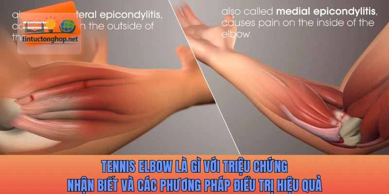 Tennis elbow là gì với triệu chứng nhận biết và các phương pháp điều trị
